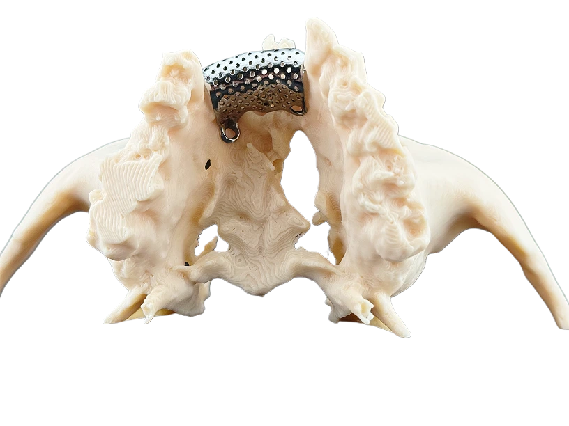 Індивідуальний титановий імплант на 3D-друкованій моделі щелепи