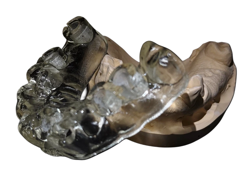 Хірургічний шаблон для імплантації — стоматологічний 3D друк